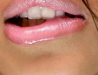 Ηλιακό έγκαυμα στα χείλια: Τρεις επιλογές θεραπείας που λίγοι γνωρίζουν